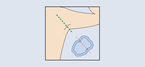 Diagram of an underarm patch showing the correct alignment with the center seam of the armpit.